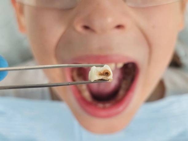 Best Emergency Dental Care for Abscessed Tooth in Frazier Park, CA